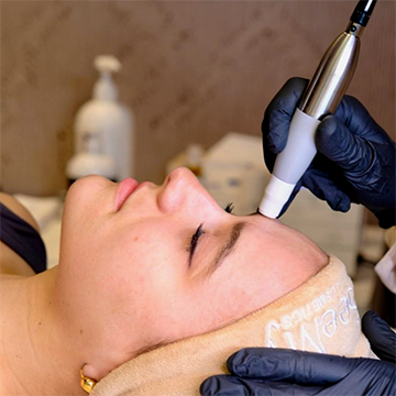 Microneedling face Microneedling face