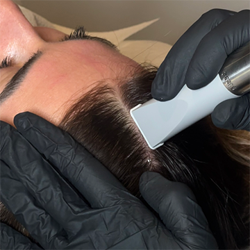 Microneedling hair (1) Microneedling hair (1)